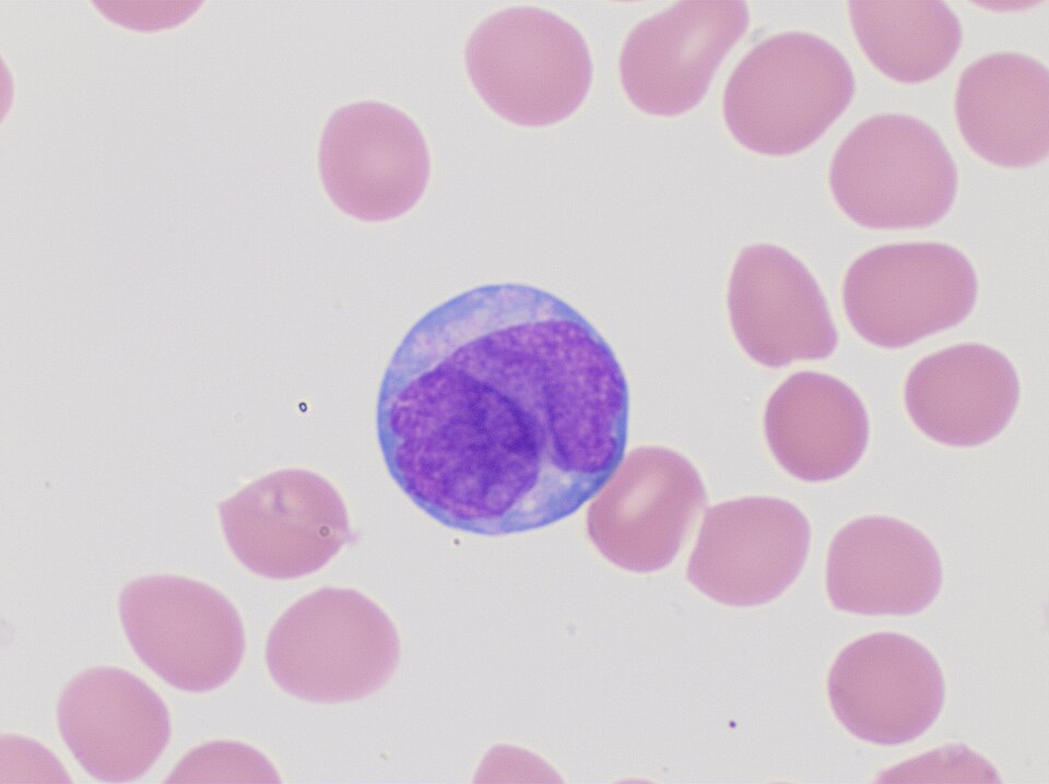 Peripheral blood smear of acute promyelocytic leukemia, hypogranular variant. Wright's stain.