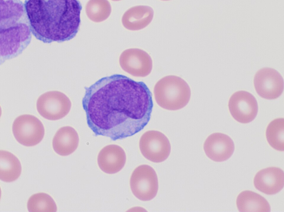 Peripheral blood smear of acute promyelocytic leukemia, hypogranular variant. Wright's stain.